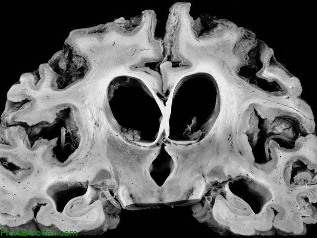 Laminar Necrosis, coronal section at level of thalmus